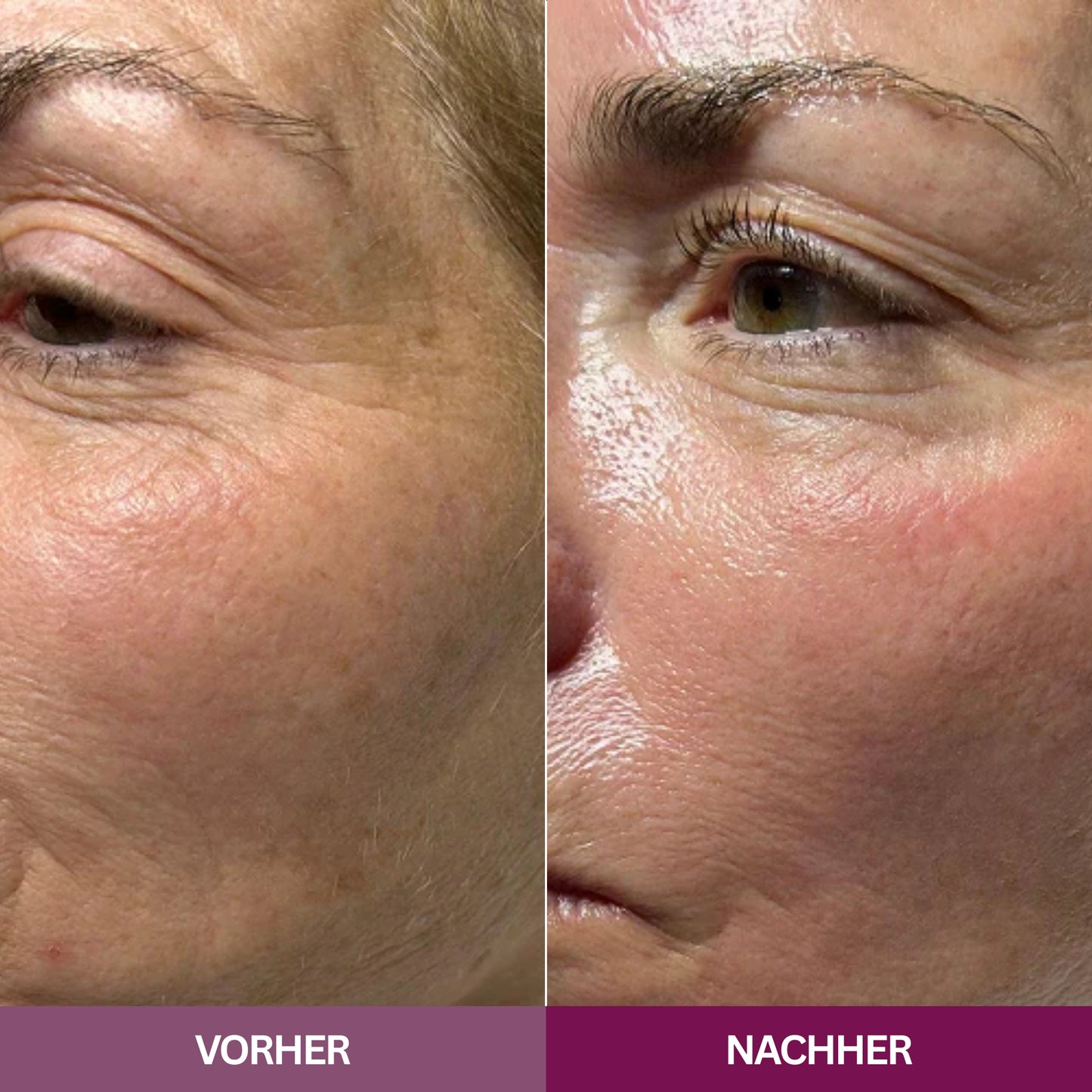 Hyaluron PDRN Orb Serum