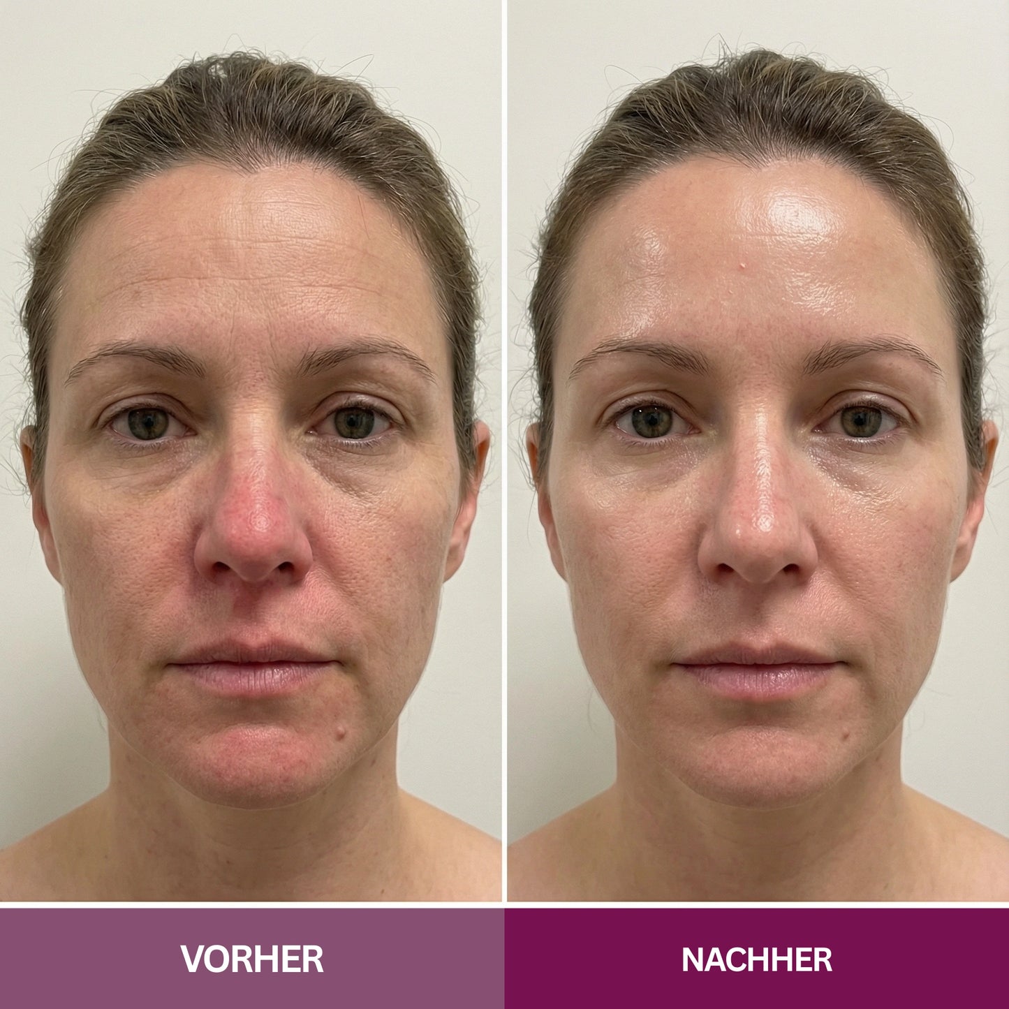 Hyaluron PDRN Orb Serum